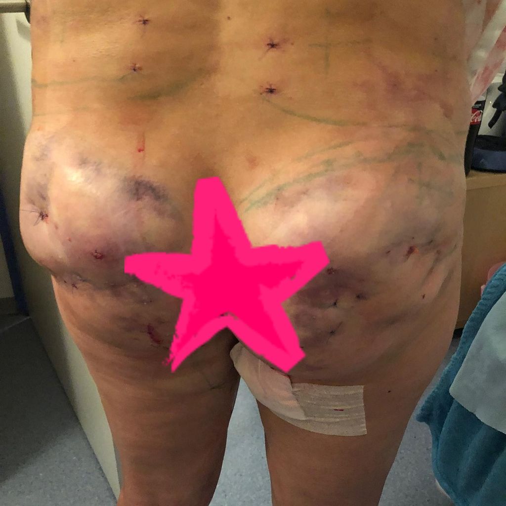 Natalia Osadas Hintern nach Brazilian Butt Lift