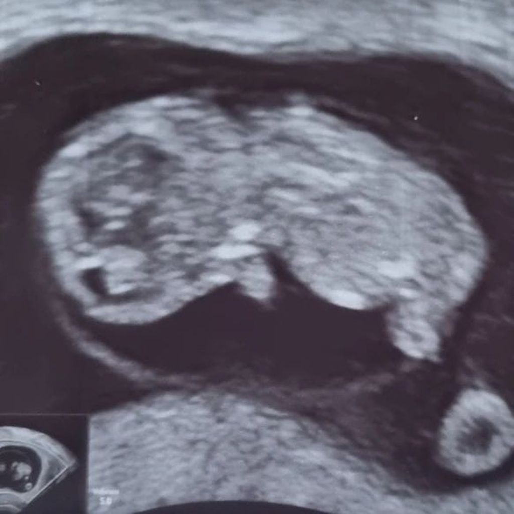 Das Baby von "Hochzeit auf den ersten Blick"-Nicole und René
