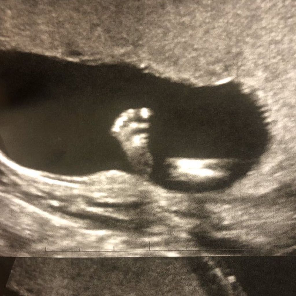 Ultraschallbild von Vanessa Morgans Baby