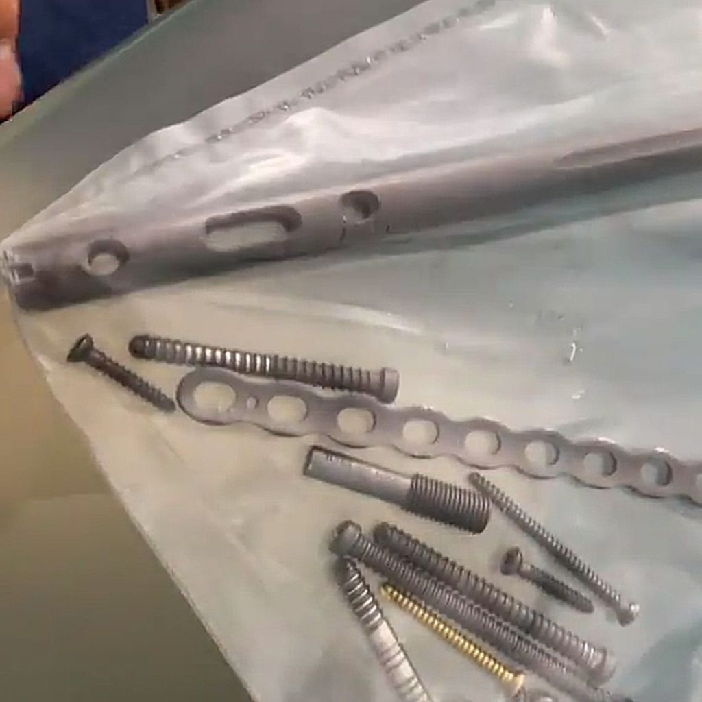 Die Nägel, Platten und Schrauben aus Sebastian Preuss' Körper