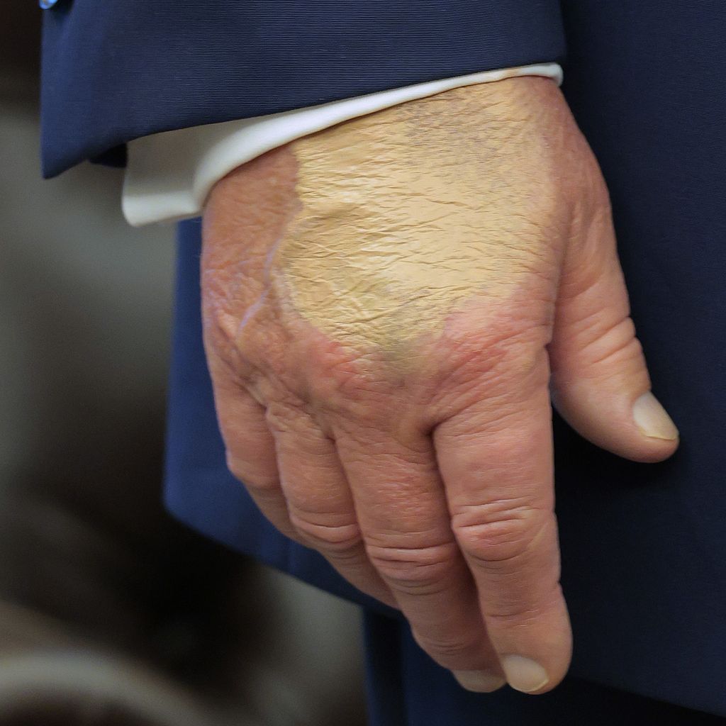 Donald Trump mit einer Verfärbung an der Hand, August 2025 in Washington