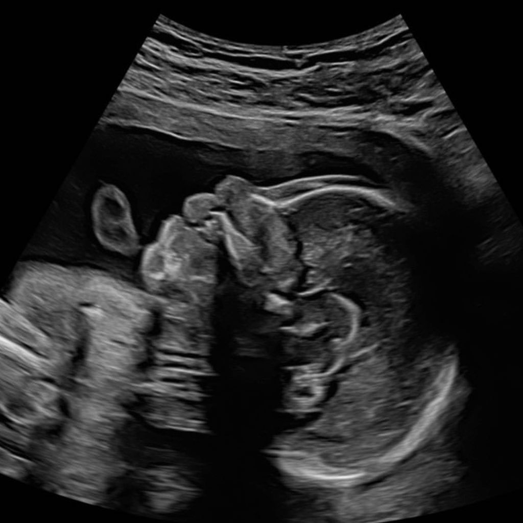 Ein Ultraschallfoto von Alex Hindermann und Laura Papendicks Baby