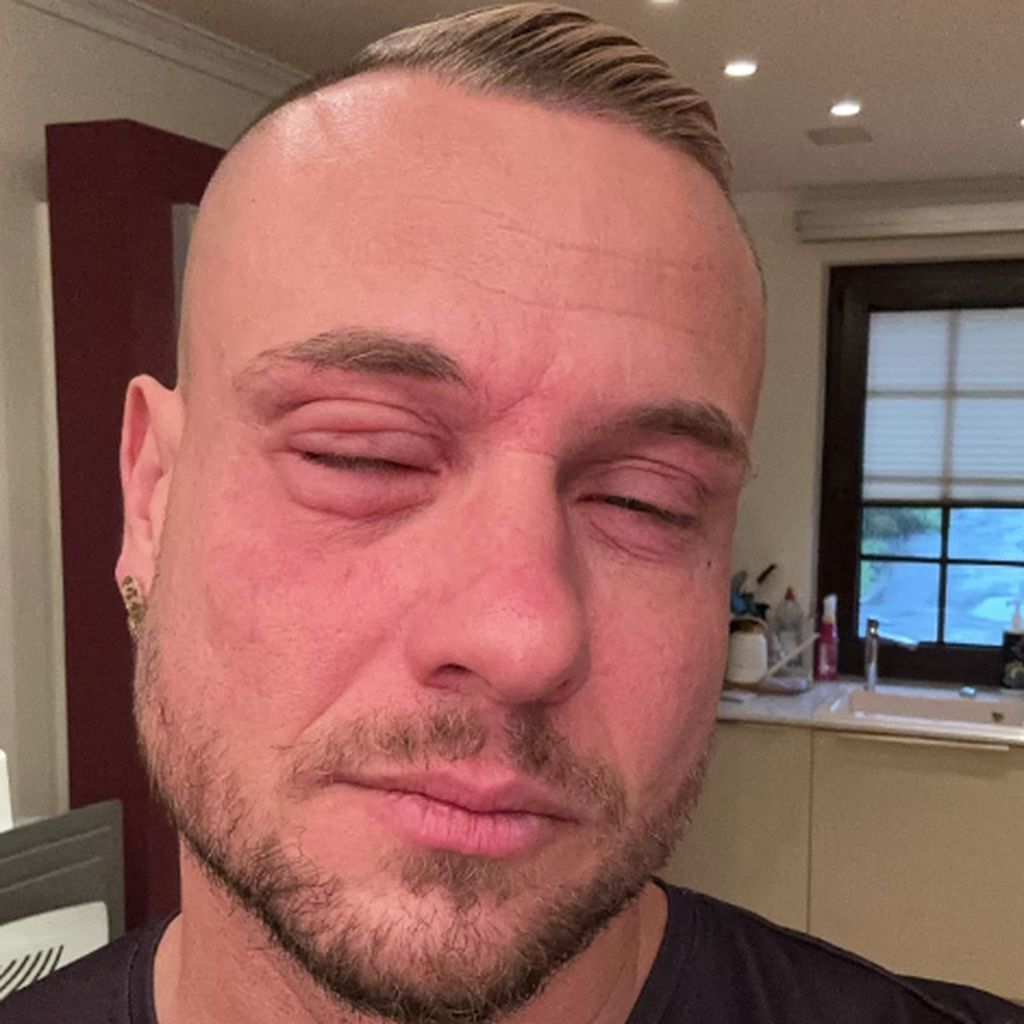 Eric Sindermann mit einer allergischen Reaktion