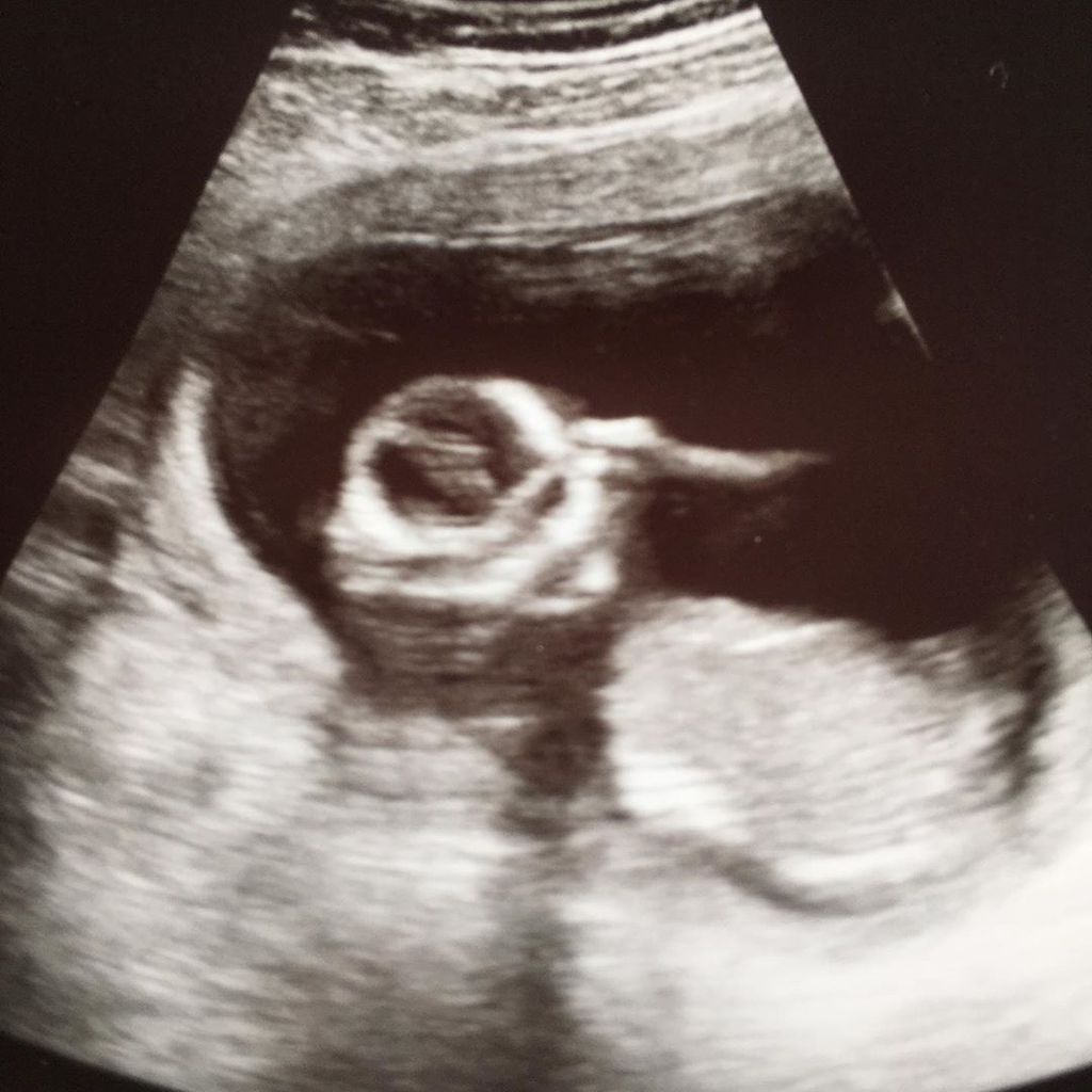 Erstes Ultraschallbild von Bear Brown und Raiven Adams Baby in der 15. Schwangerschaftswoche