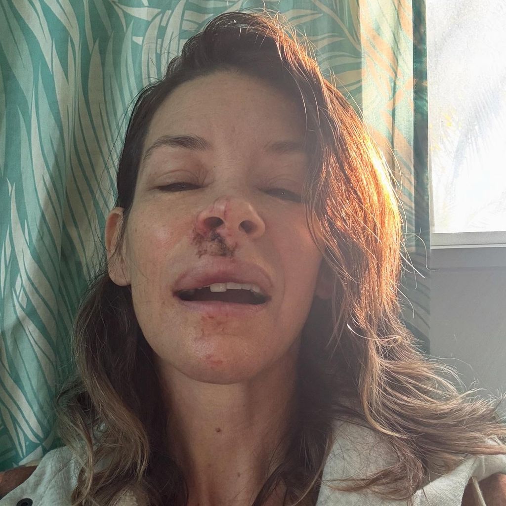Evangeline Lilly zeigt ihre Gesichtsverletzungen