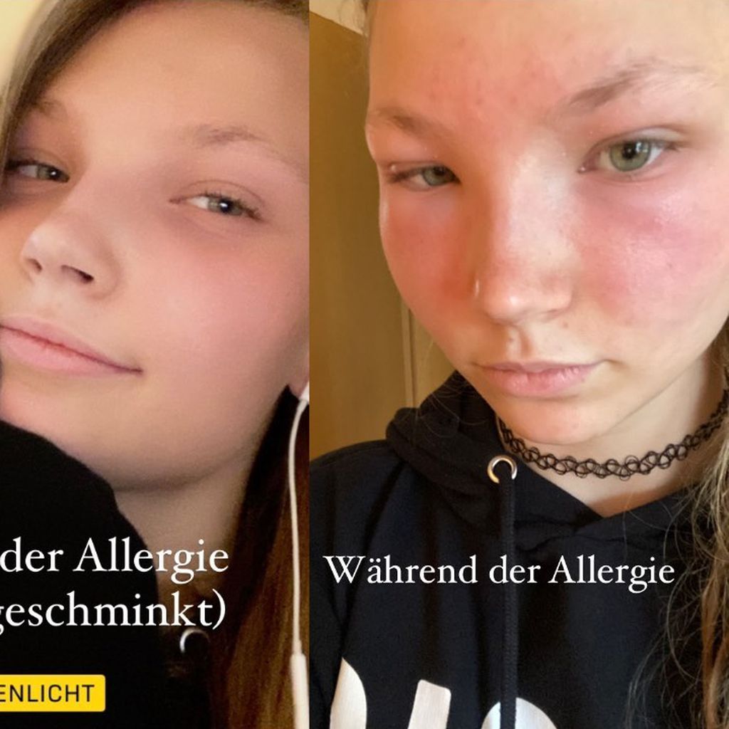 GNTM-Romy ohne und mit allergischer Reaktion im Gesicht