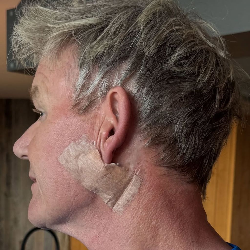 Gordon Ramsay zeigt sein Gesicht nach der Hautkrebs-Operation