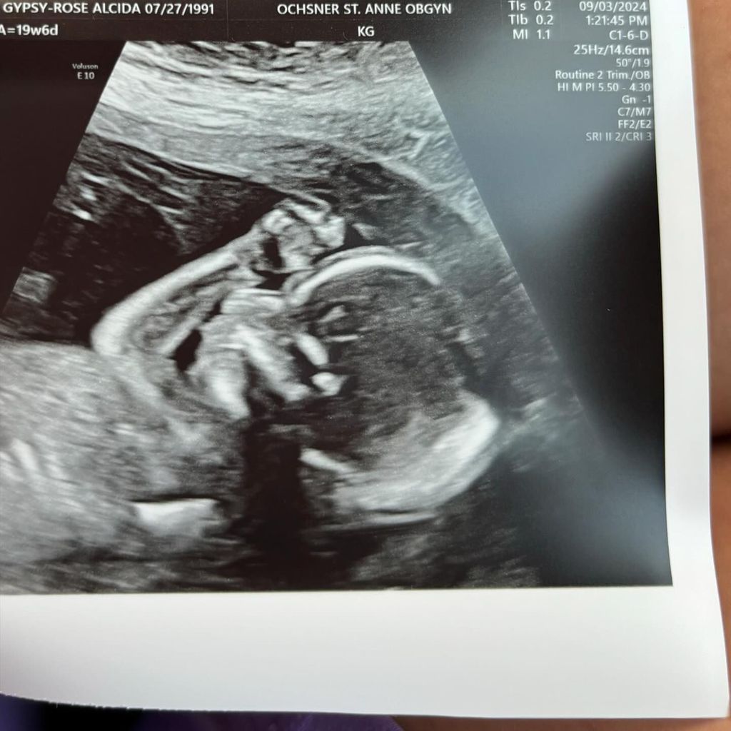 Gypsy Rose Blanchards Ultraschallbild im September 2024
