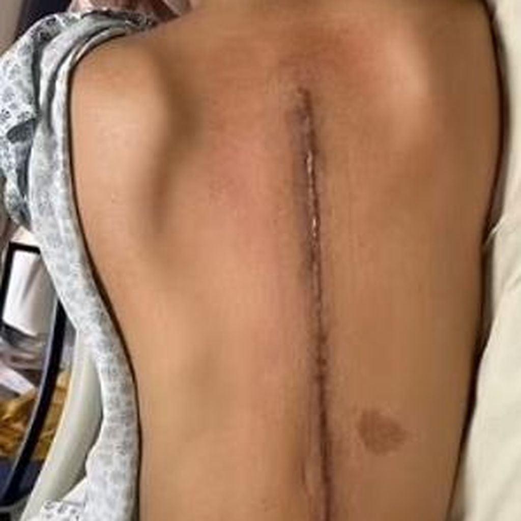 Jacki Apostels Rückennarbe