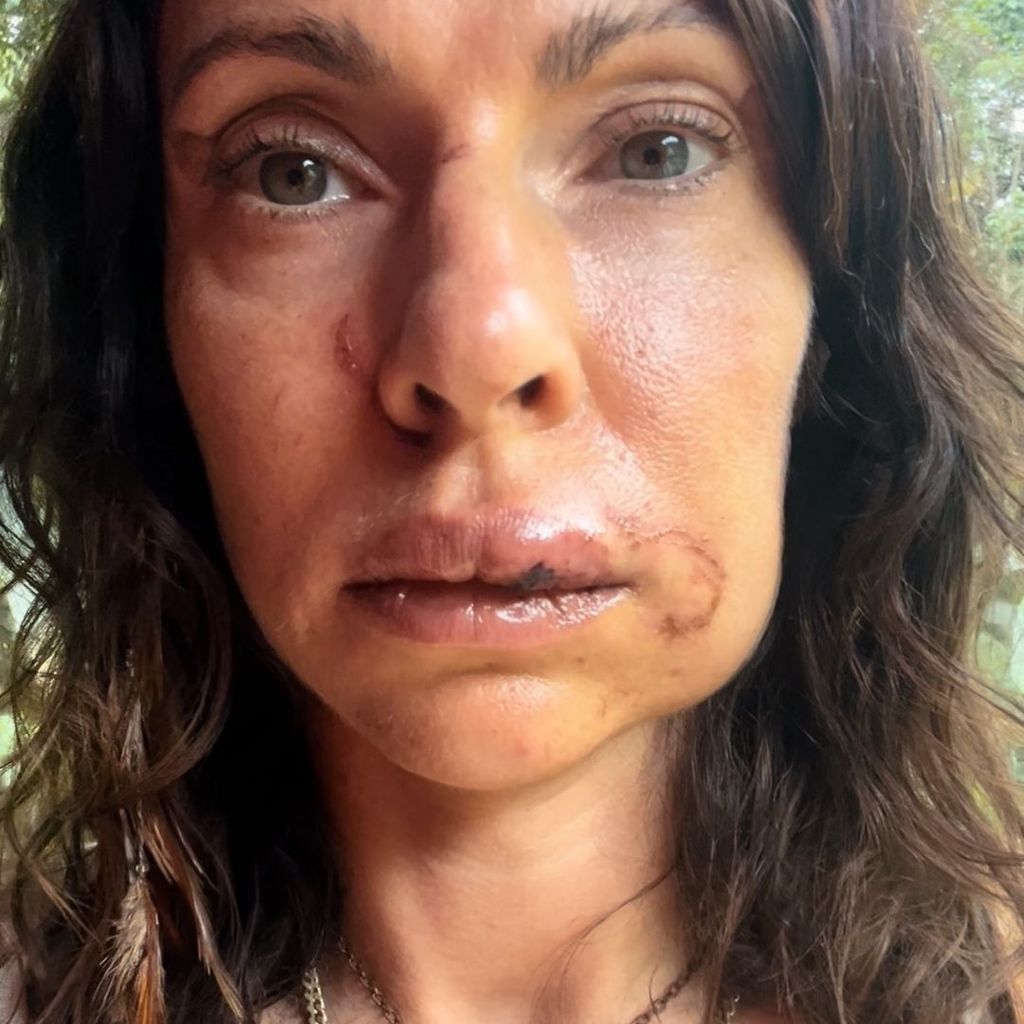 Jana Pallaske nach ihrem Überfall