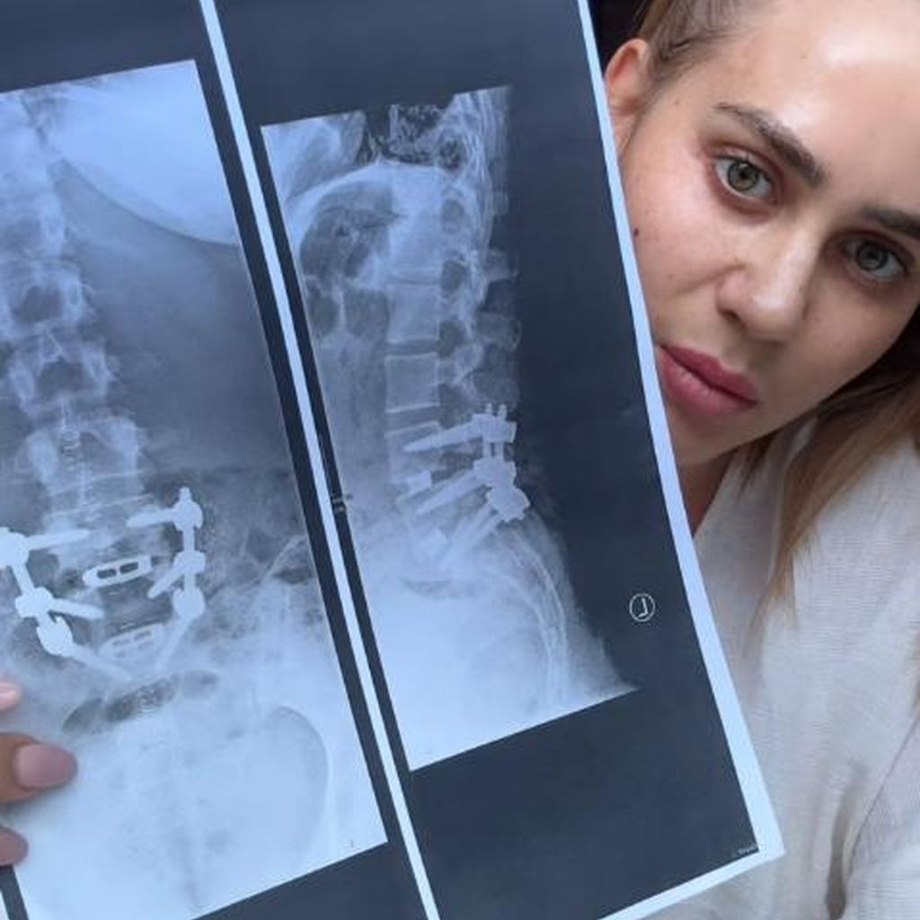 Jessica Hallers Wirbelsäule nach der Operation