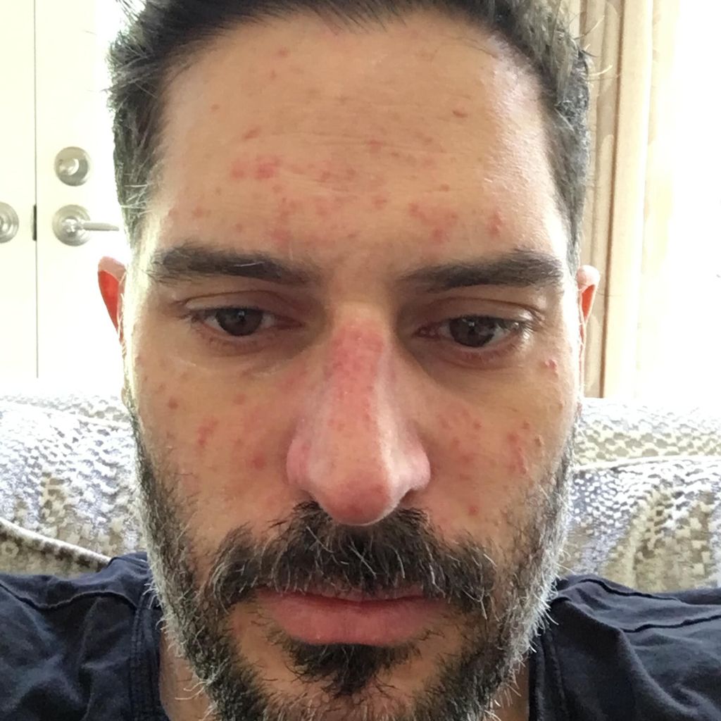Joe Manganiello zeigt die Auswirkung seiner Krankheit auf sein Hautbild