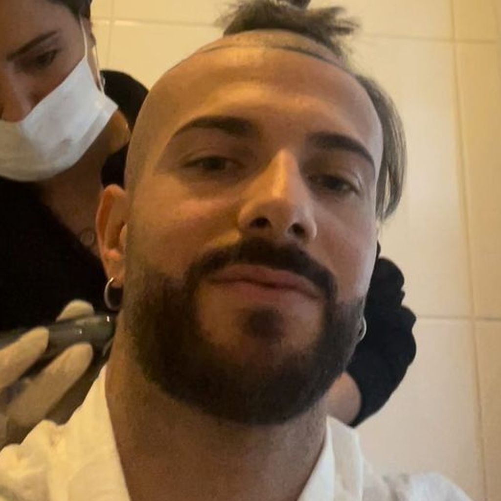 Julian Evangelos vor seiner Haartransplantation