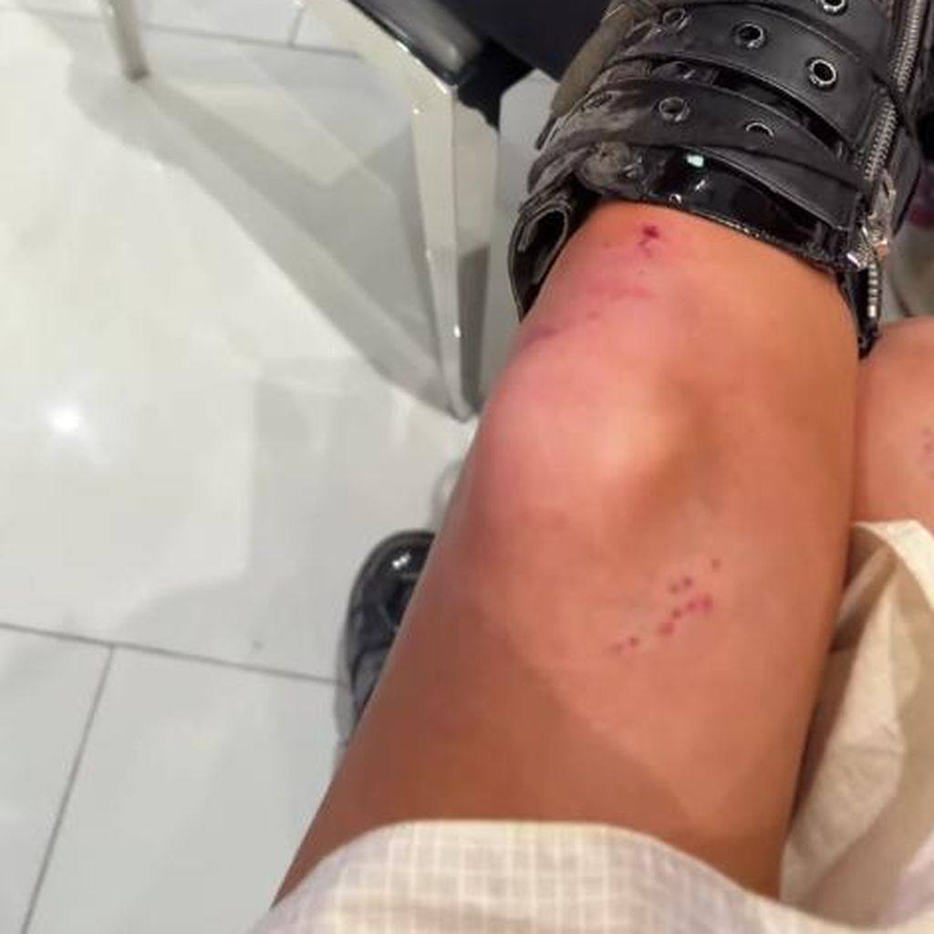 Kate Beckinsales Verletzung am Bein, im Juli 2024
