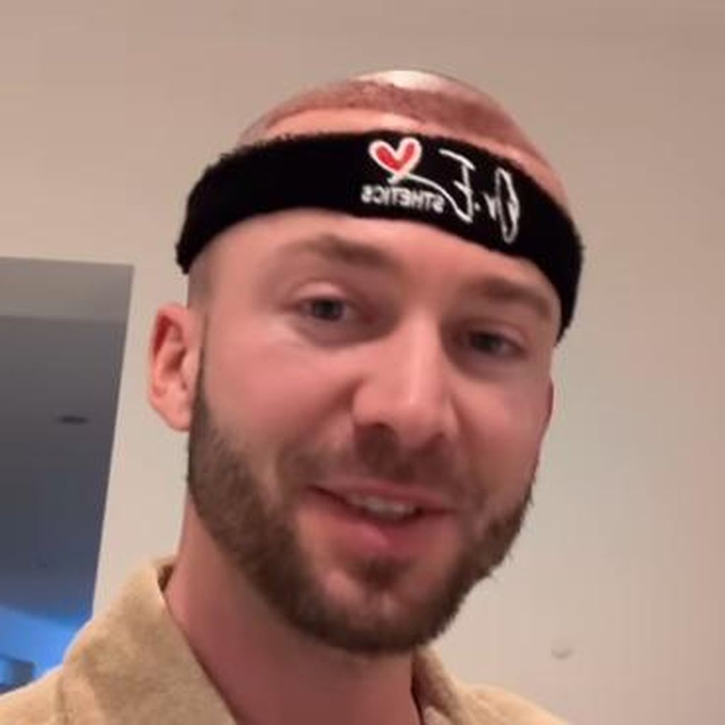 Keno Rüst nach seiner Haartransplantation 2024