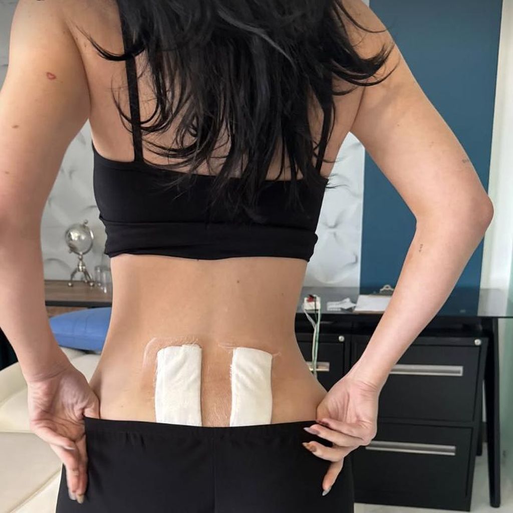 Kylie Jenner nach der Stammzellentherapie.