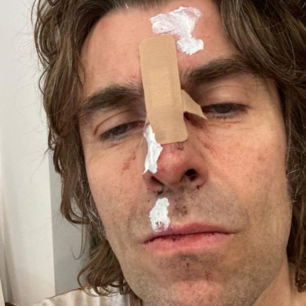 Liam Gallagher nach seinem Unfall im September 2021