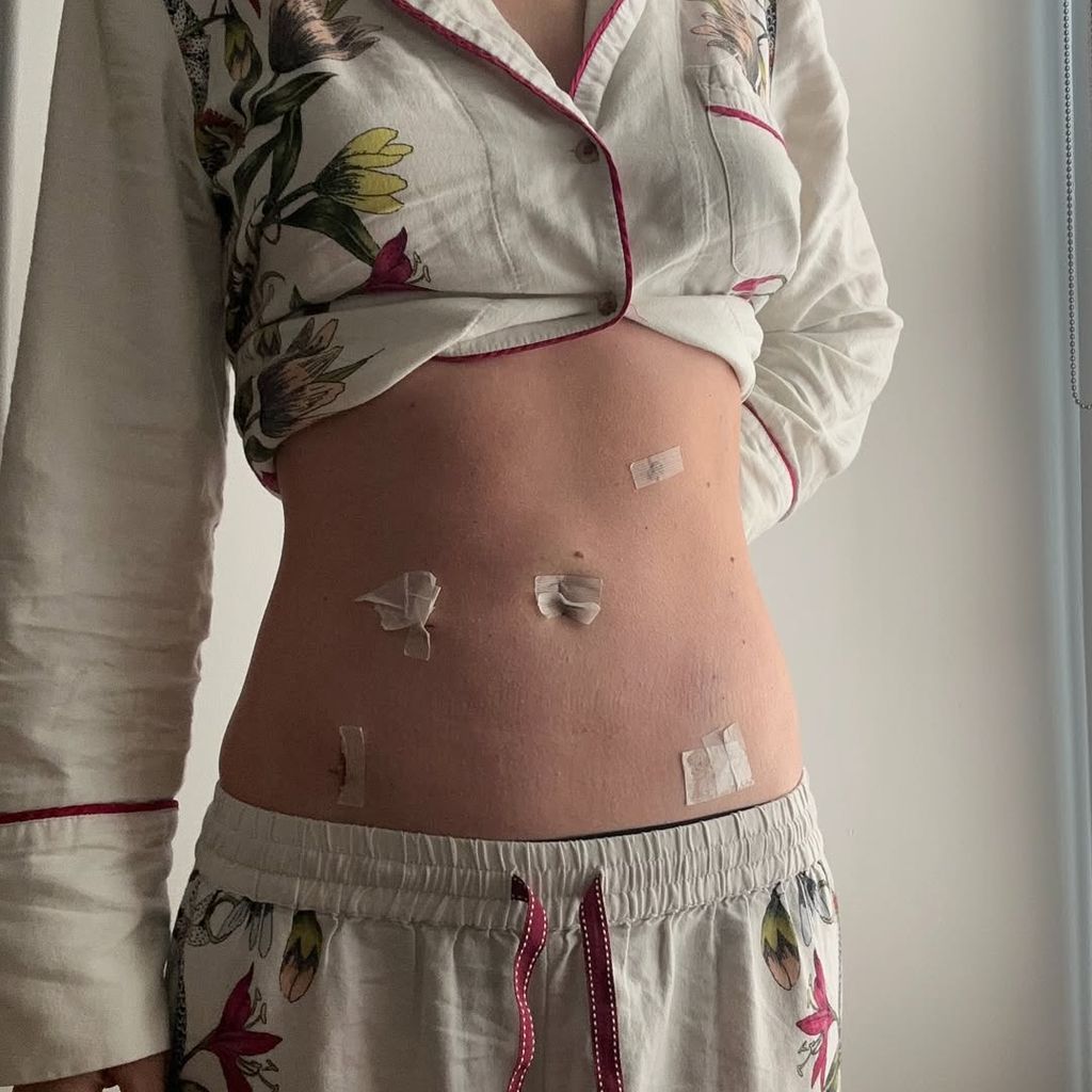 Lili Reinhart zeigt ihren Bauch nach der OP, 2025