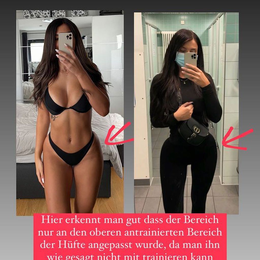 Lisa del Piero vor und nach ihrer Hipdip-OP