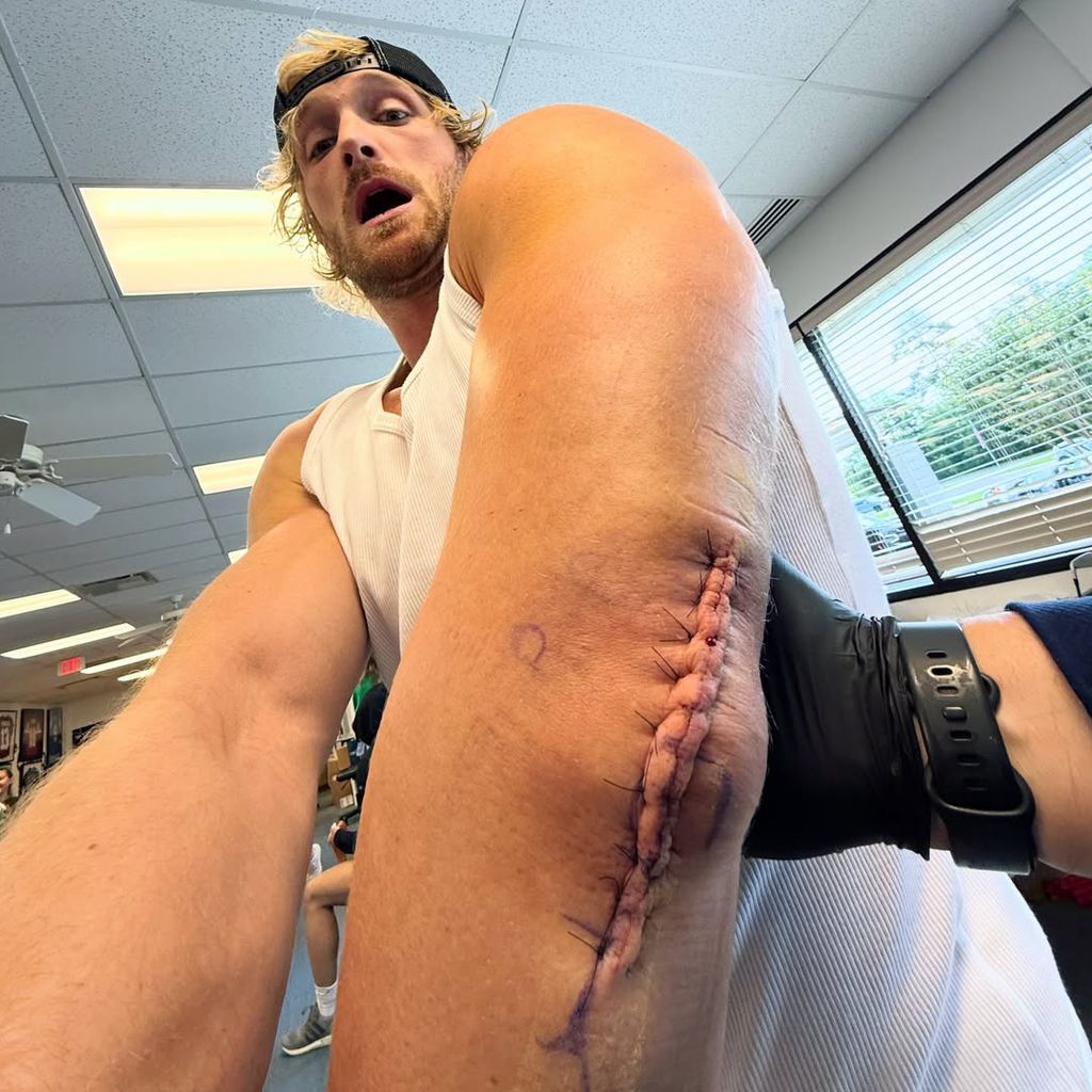 Logan Pauls XXL-Narbe nach dem Eingriff, Mai 2026