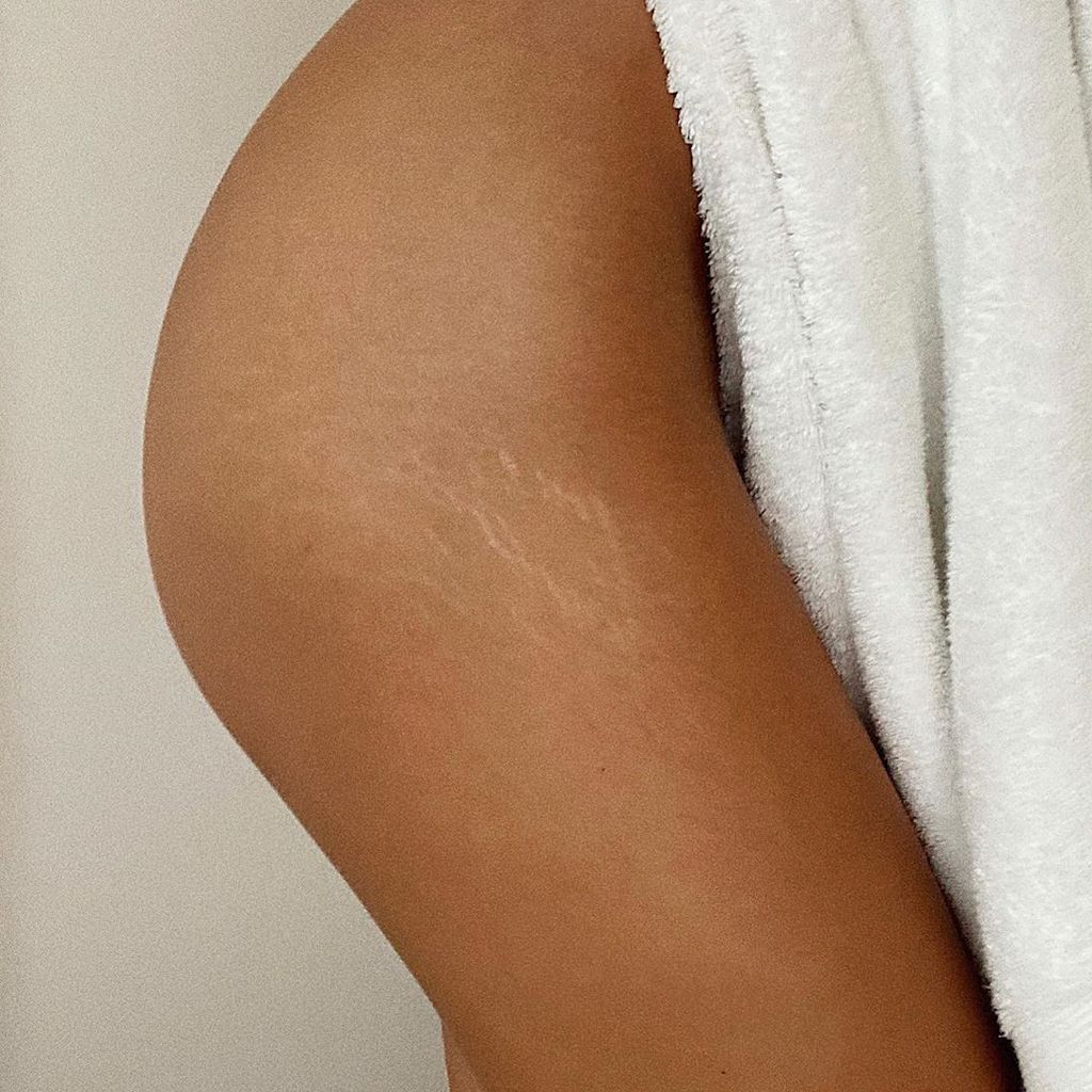 Model Lorena Rae zeigt ihre Dehnungsstreifen