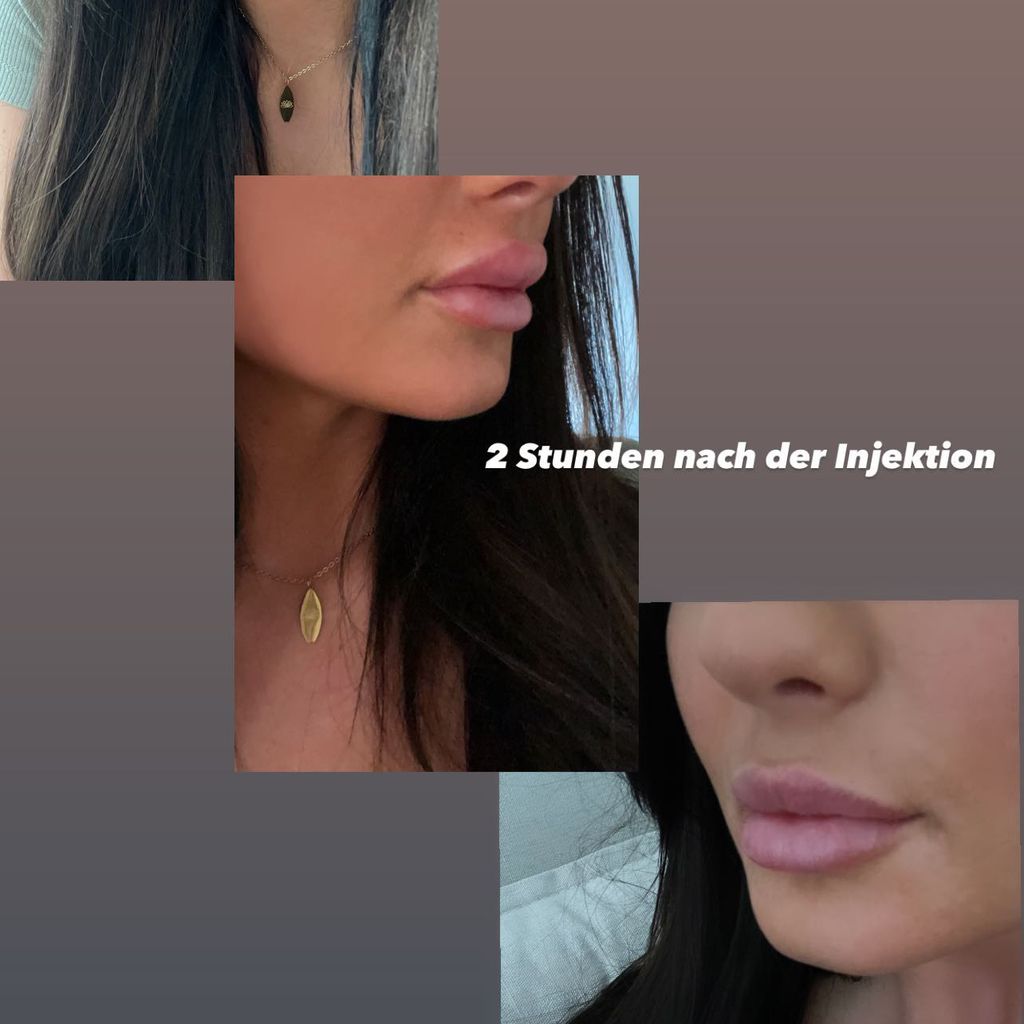 "Love Island"-Star Lauras Lippenveränderung
