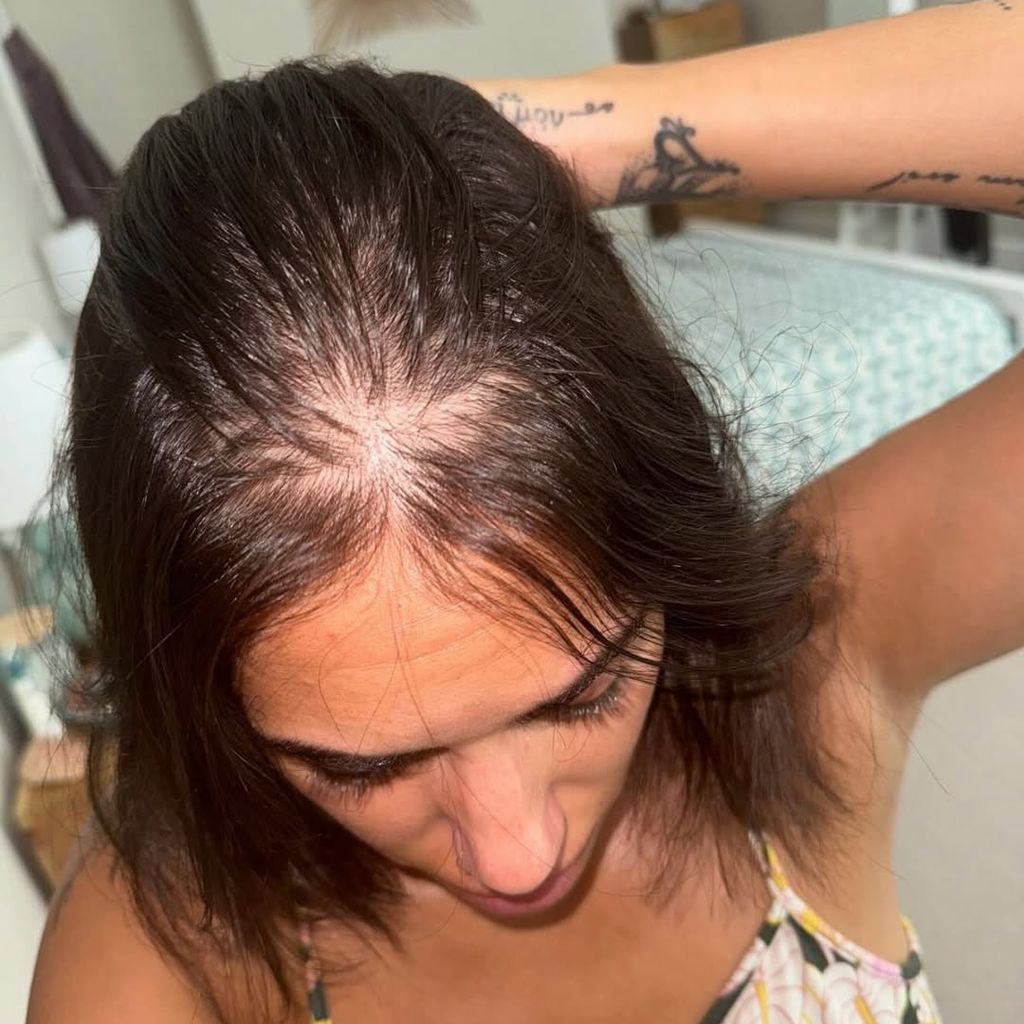 Malin Andersson zeigt auf Instagram ihren Haarausfall