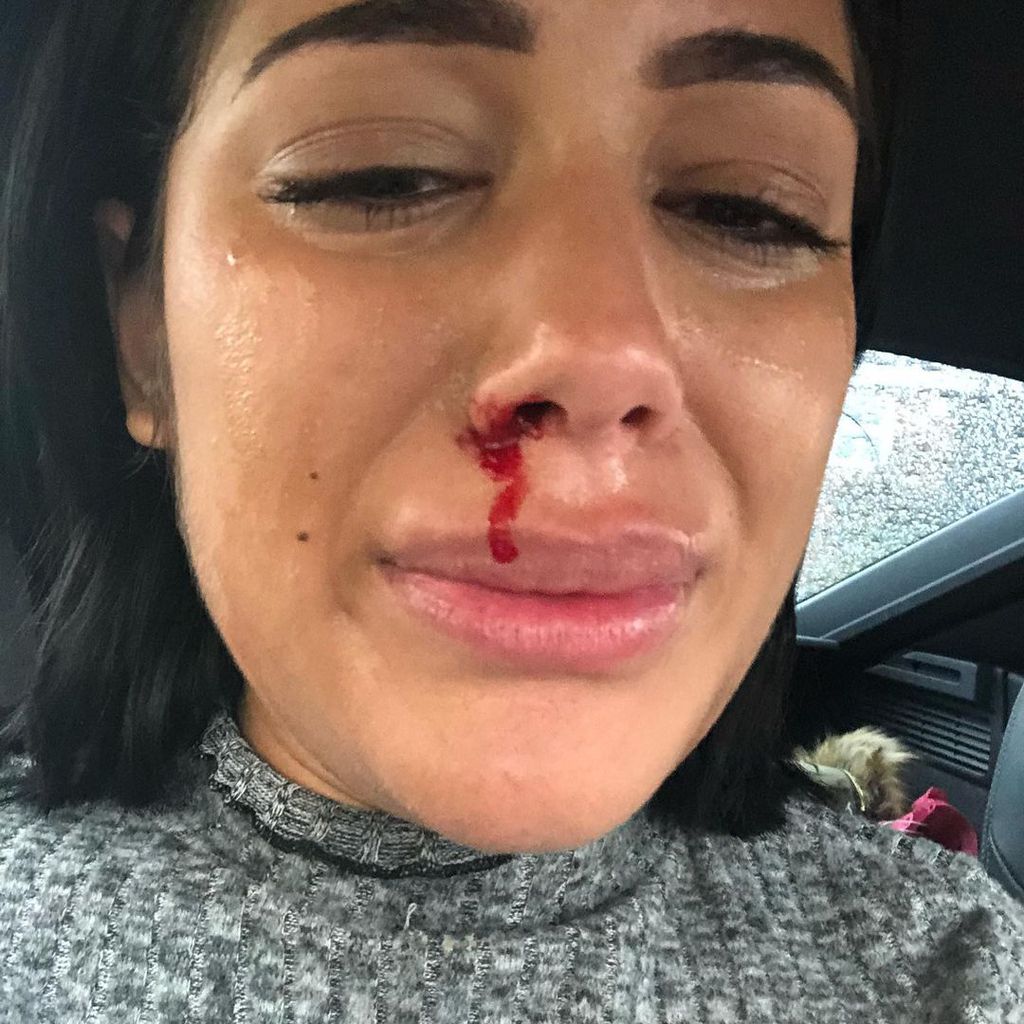 Malin Andersson mit Verletzungen im Gesicht