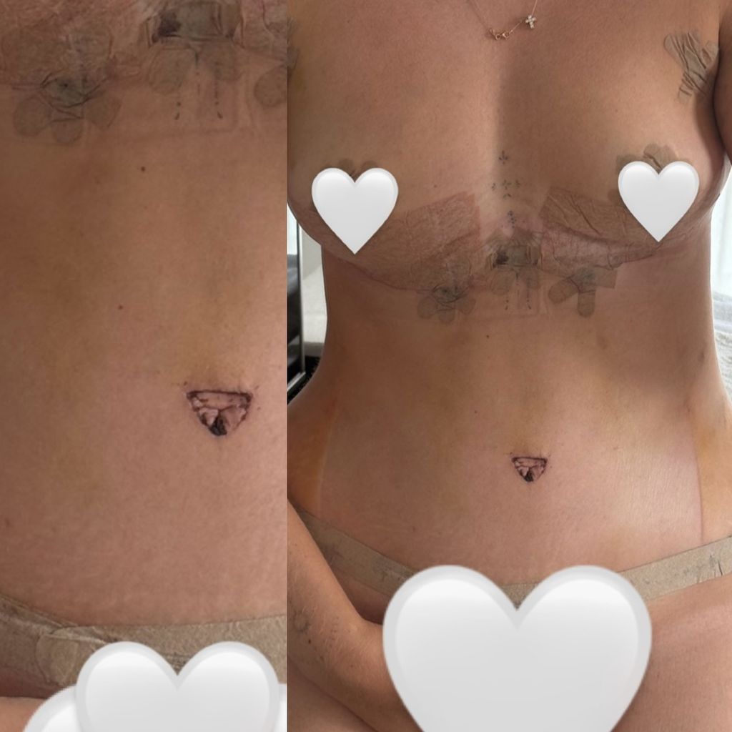 Maren Wolfs Körper nach der Brust-OP
