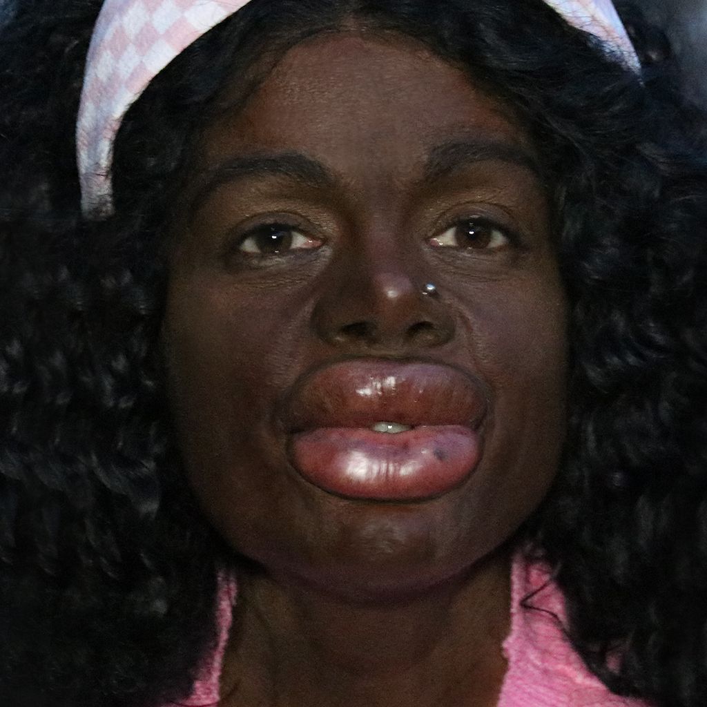 Martina Big nach ihrer Lippeninjektion im April 2025