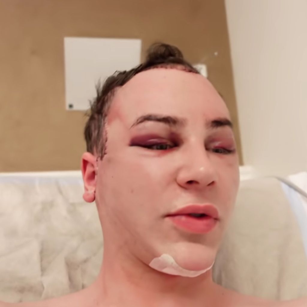 Marvyn Macnificent nach seiner Gesichtsfeminisierungs-OP