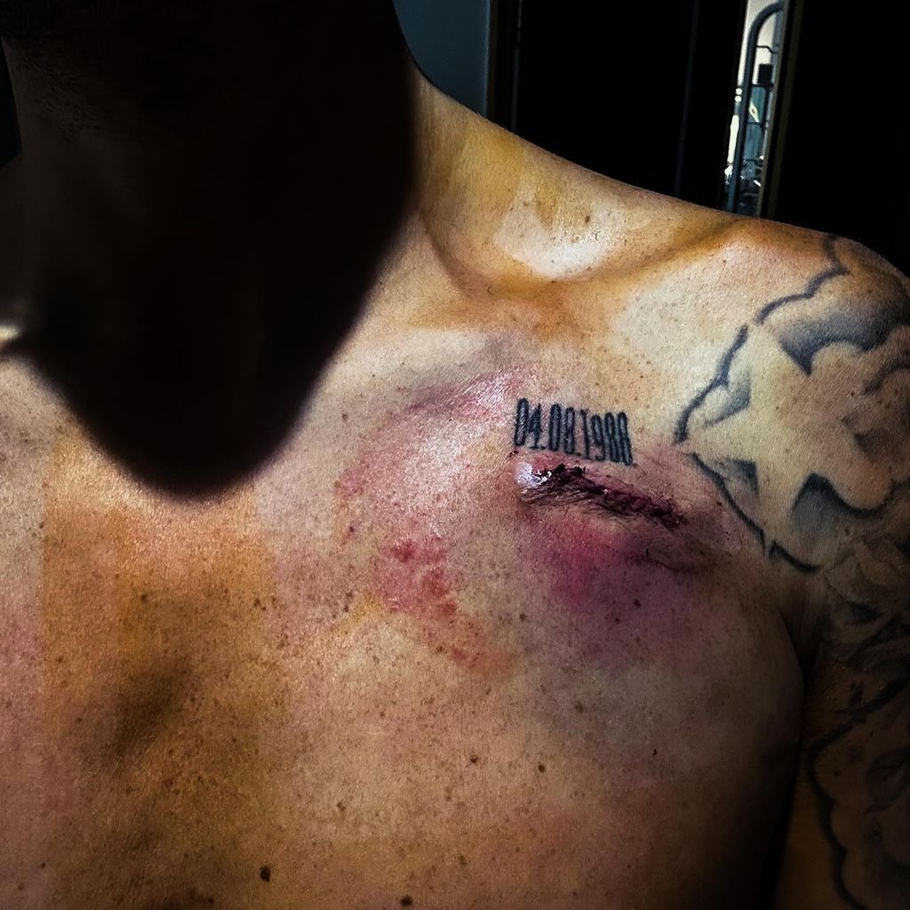 Max George mit seiner Herzschrittmacher-Narbe