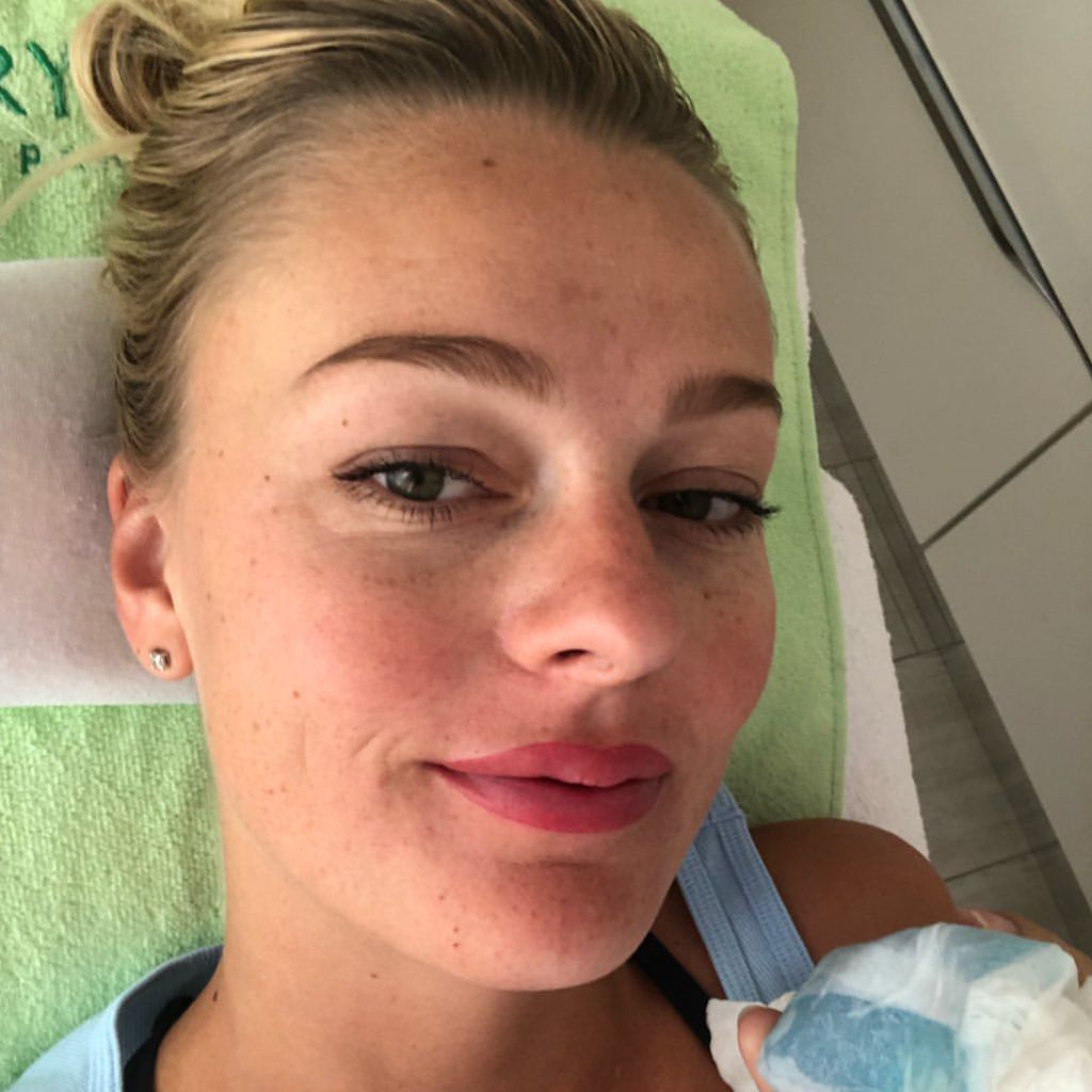 Miriam Höller nach der Pigmentierung ihrer Lippen