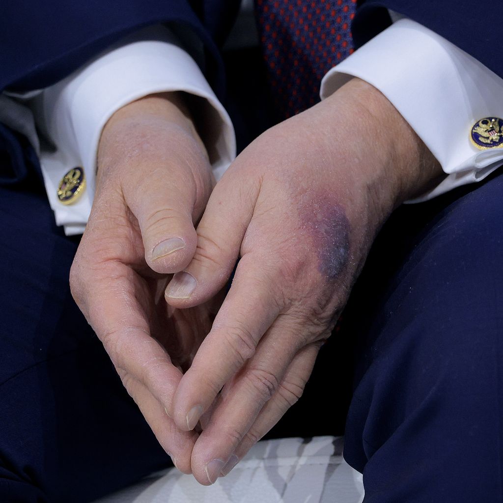 Ein blauer Fleck ziert die linke Hand des US-Präsidenten