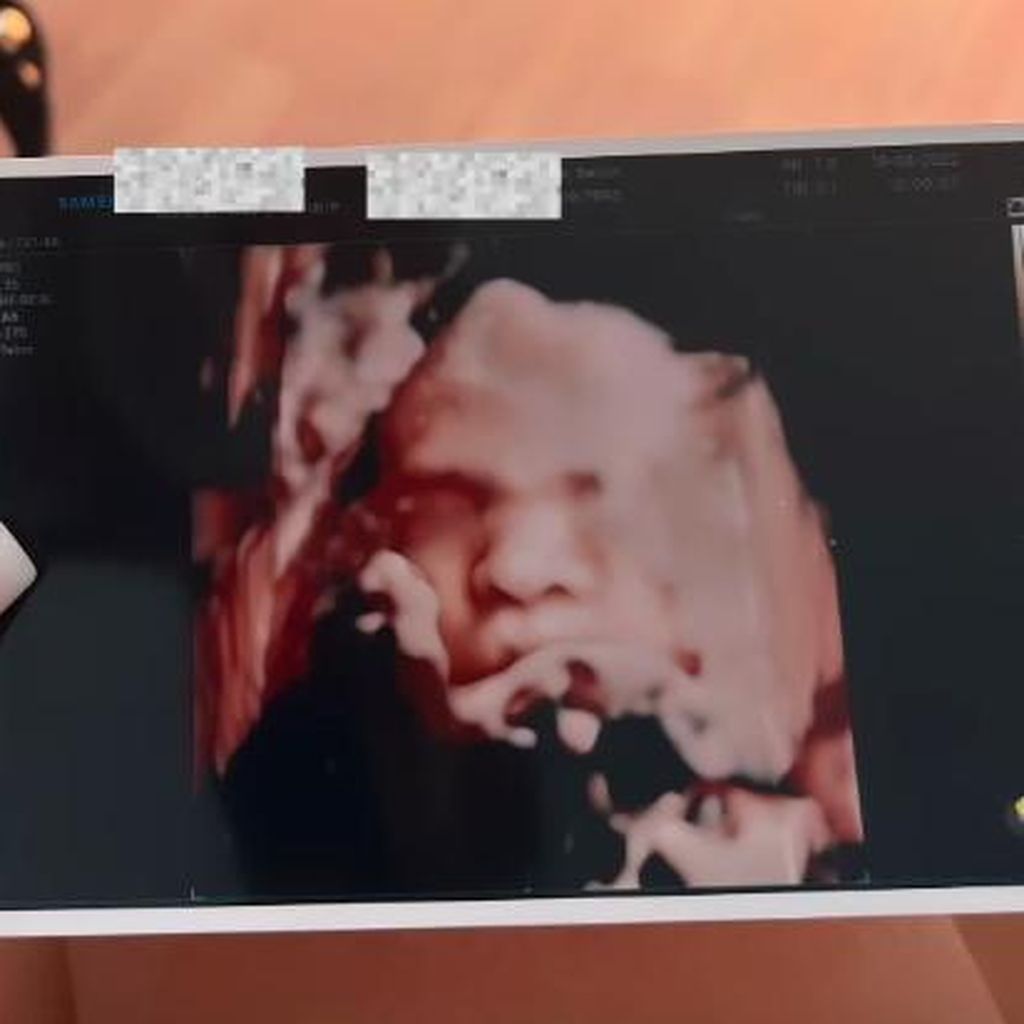 Ultraschallfoto von Nathalie Bleicher-Woths Sohn