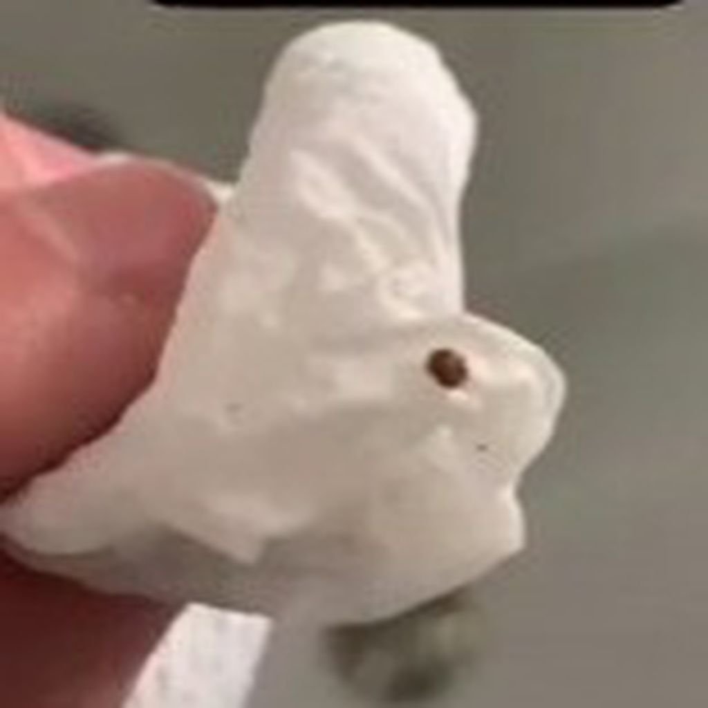 Nierenstein von Andre Schiebler