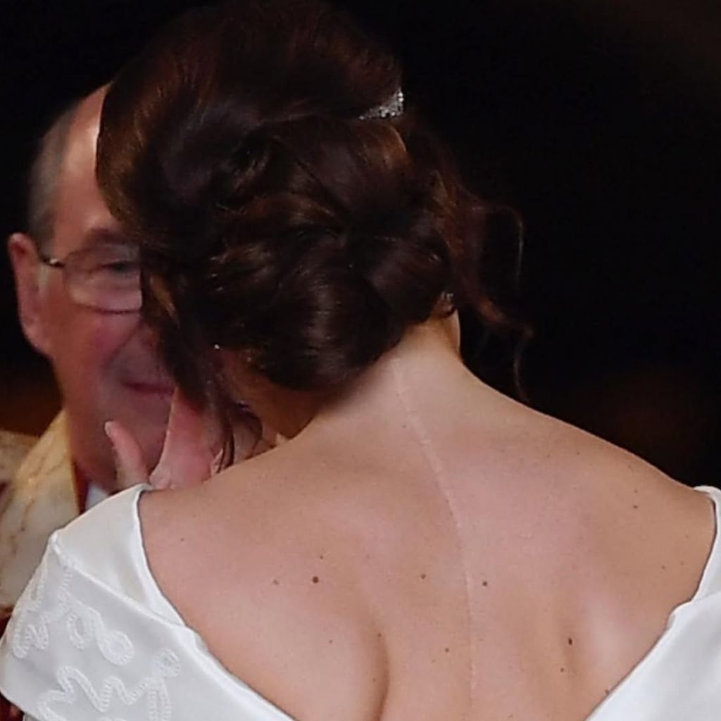 Prinzessin Eugenie mit ihrer Narbe