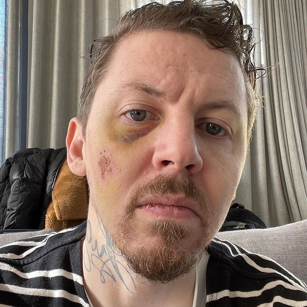 Professor Green zeigt seine Verletzungen vom April 2022