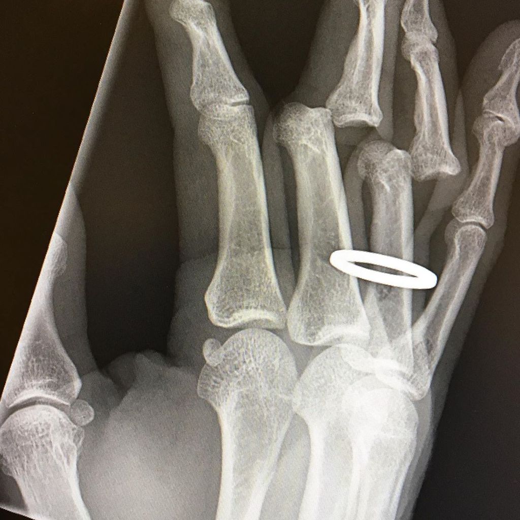 Röntgenaufnahme von Tony Hawks Hand