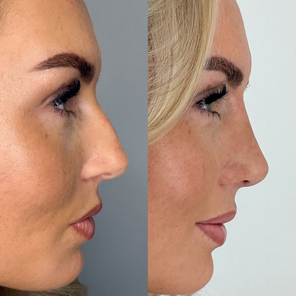 Vorher-Nachher-Vergleich von Sarah Liebich