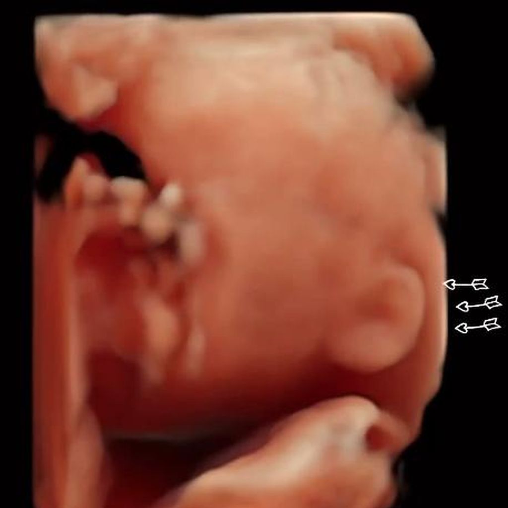 Ultraschallbild von Philipp Stehlers Baby, Februar 2023