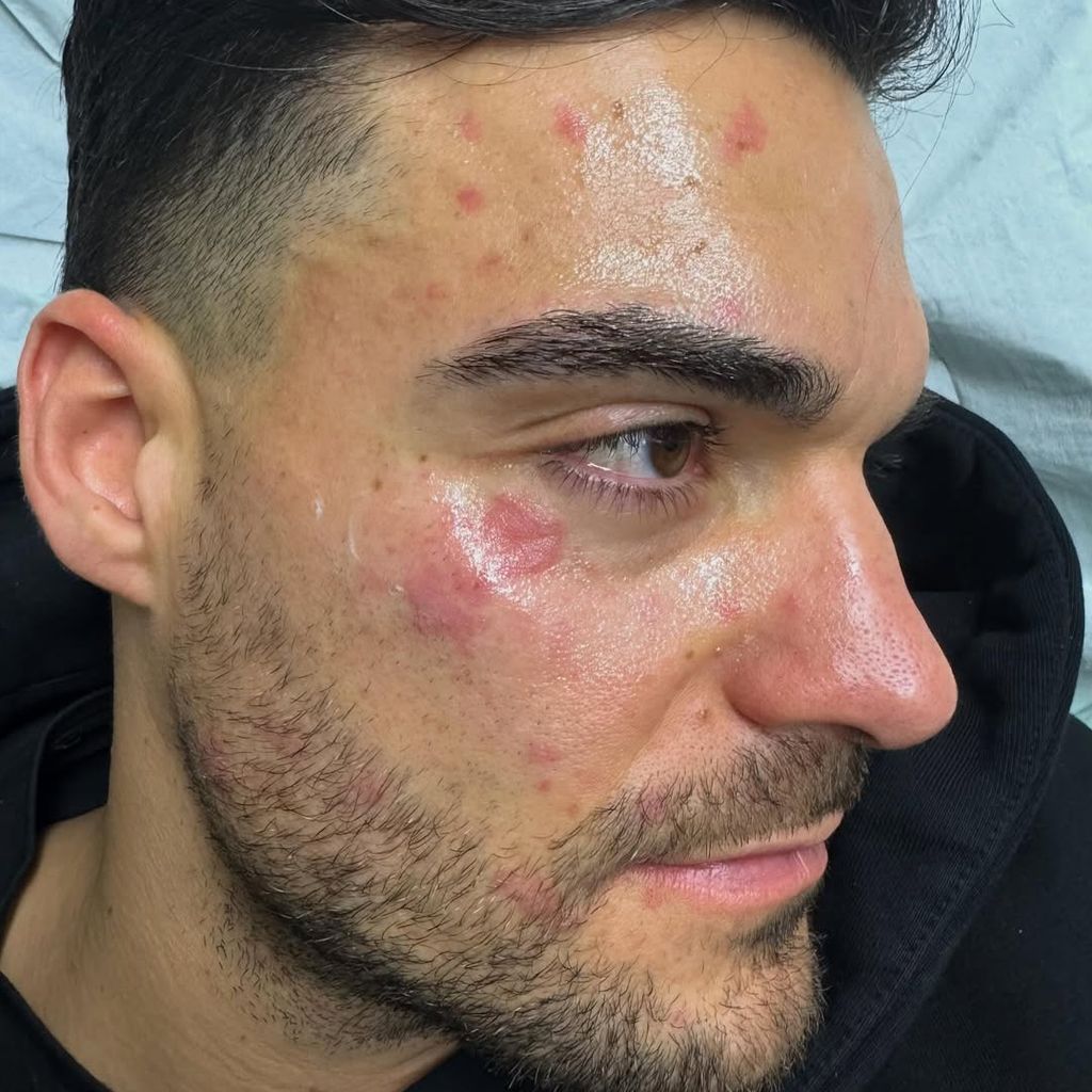 Stefano Zarella nach Küchenunfall 2025