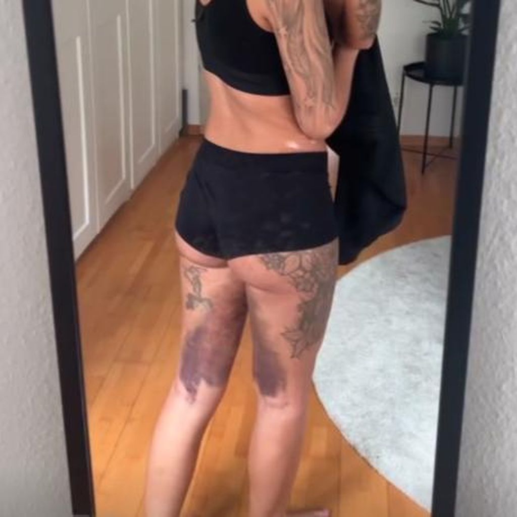 Stephie Stark mit ihren blauen Flecken nach der OP