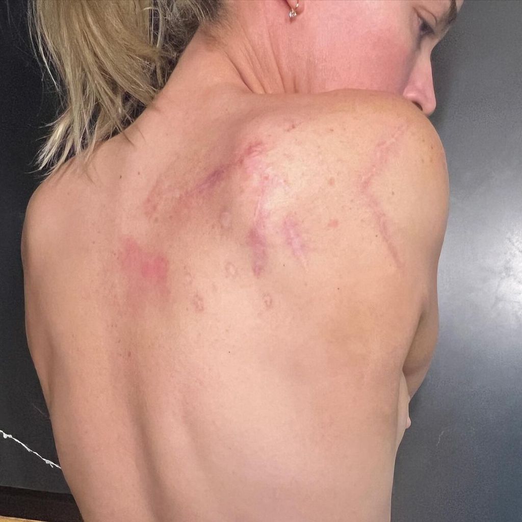 Teddi Mellencamp zeigt ihren vernarbten Rücken, Dezember 2023
