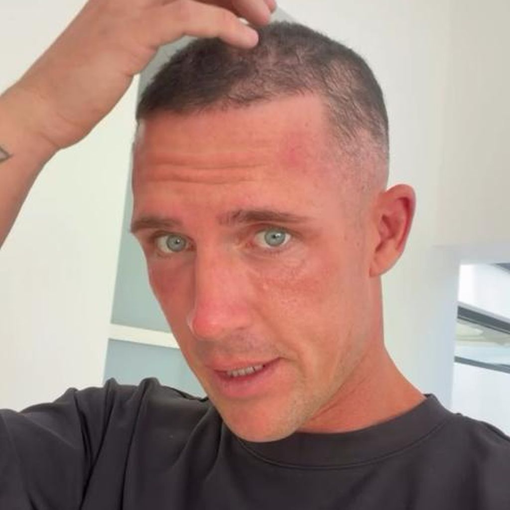 Influencer Tobias Wolf leidet an kreisrundem Haarausfall, April 2026