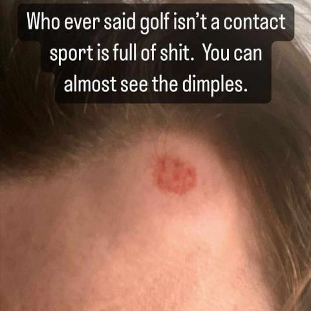 Tom Holland mit einer Golfverletzung