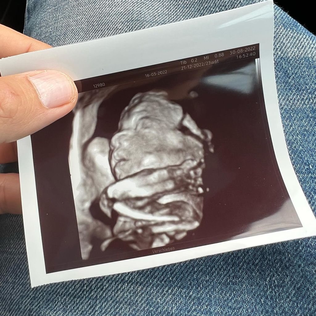 Ultraschallfoto von Ufo361s Nachwuchs