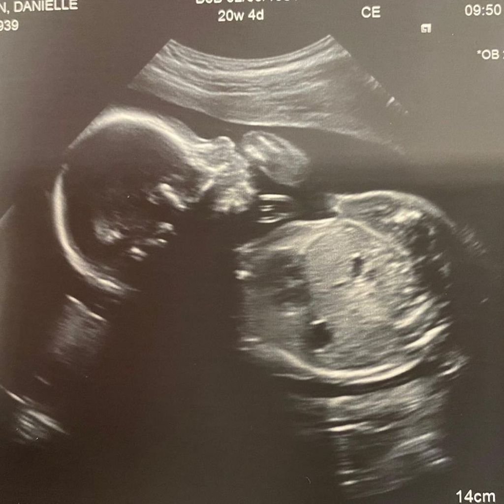 Ultrallschallaufnahme von Brian McFaddens ungeborenem Baby