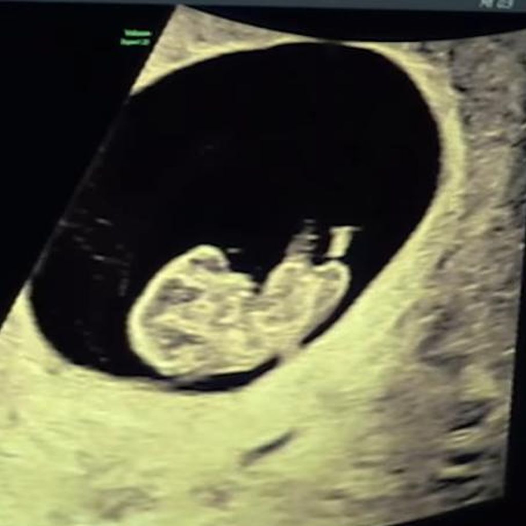 Ultraschall von Jamie Laing und Sophie Habboos Baby