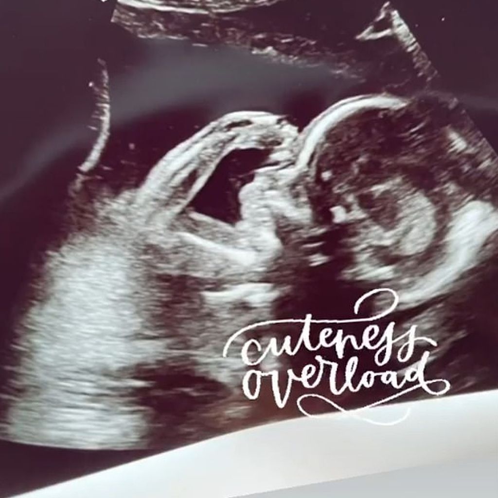 Ultraschall von Kimberley Welshs Baby